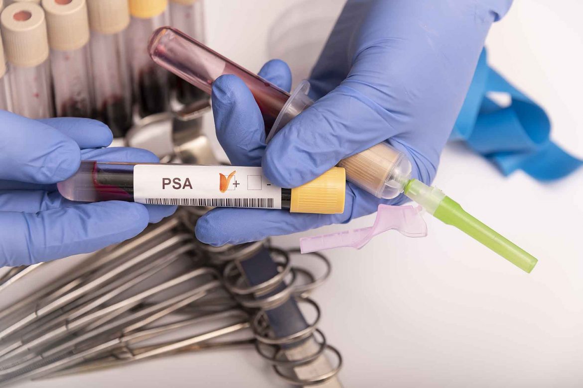 Antigene prostatico specifico
